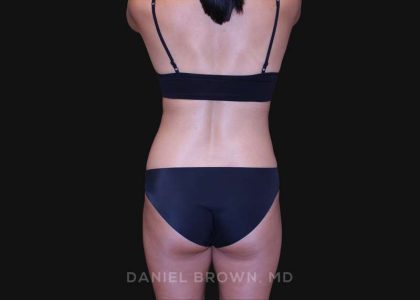 Tummy Tuck Before & After Patient #10877