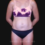Tummy Tuck Before & After Patient #10877