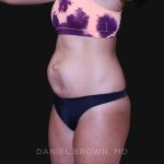 Tummy Tuck Before & After Patient #10877
