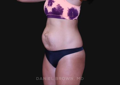 Tummy Tuck Before & After Patient #10877