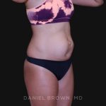 Tummy Tuck Before & After Patient #10877
