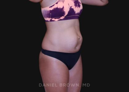 Tummy Tuck Before & After Patient #10877