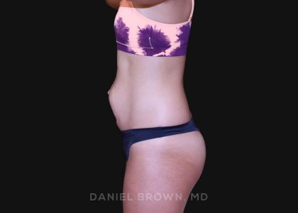 Tummy Tuck Before & After Patient #10877