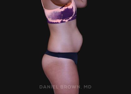 Tummy Tuck Before & After Patient #10877