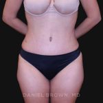 Tummy Tuck Before & After Patient #10890
