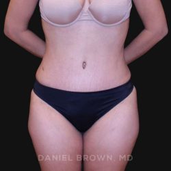 Tummy Tuck Before & After Patient #10890