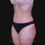 Tummy Tuck Before & After Patient #10890