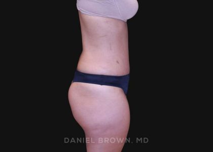 Tummy Tuck Before & After Patient #10890