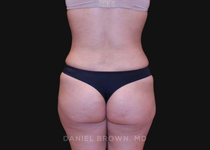 Tummy Tuck Before & After Patient #10890