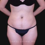 Tummy Tuck Before & After Patient #10890