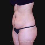 Tummy Tuck Before & After Patient #10890