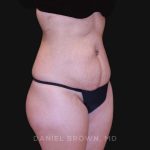 Tummy Tuck Before & After Patient #10890