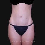 Tummy Tuck Before & After Patient #10903