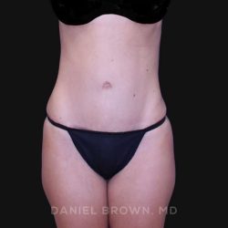 Tummy Tuck Before & After Patient #10903