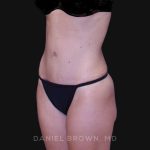 Tummy Tuck Before & After Patient #10903