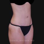 Tummy Tuck Before & After Patient #10903