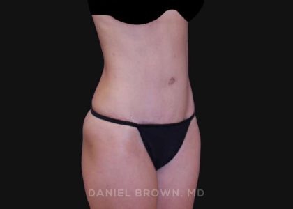 Tummy Tuck Before & After Patient #10903