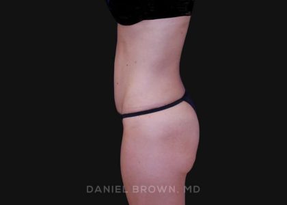 Tummy Tuck Before & After Patient #10903