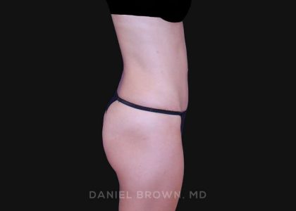 Tummy Tuck Before & After Patient #10903