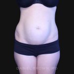 Tummy Tuck Before & After Patient #10903