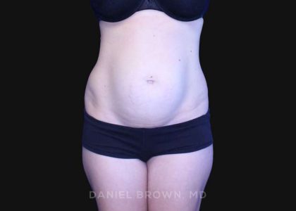 Tummy Tuck Before & After Patient #10903