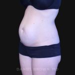 Tummy Tuck Before & After Patient #10903