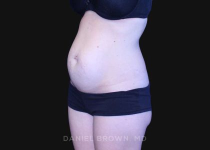 Tummy Tuck Before & After Patient #10903
