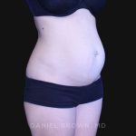 Tummy Tuck Before & After Patient #10903