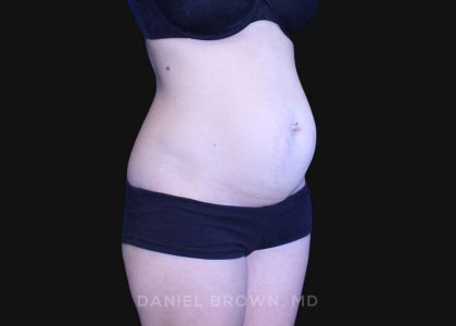 Tummy Tuck Before & After Patient #10903