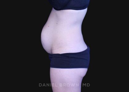 Tummy Tuck Before & After Patient #10903