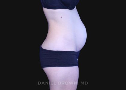 Tummy Tuck Before & After Patient #10903