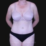 Tummy Tuck Before & After Patient #10916