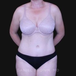 Tummy Tuck Before & After Patient #10916