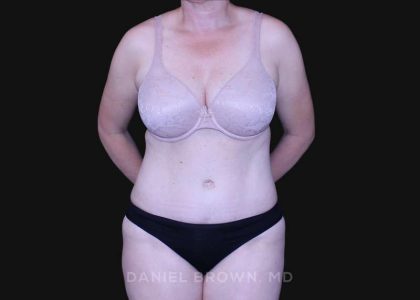 Tummy Tuck Before & After Patient #10916