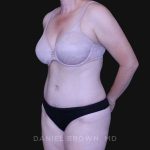 Tummy Tuck Before & After Patient #10916