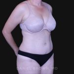 Tummy Tuck Before & After Patient #10916