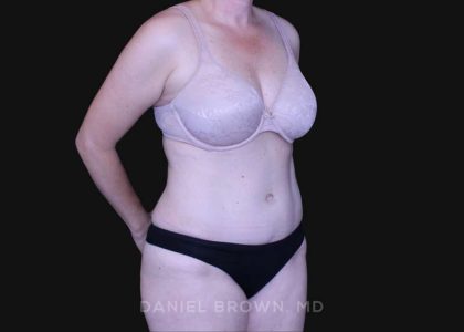 Tummy Tuck Before & After Patient #10916