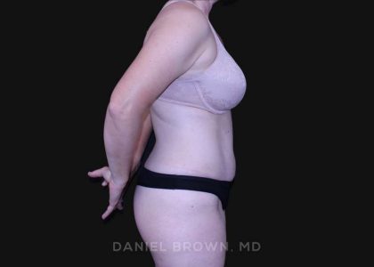 Tummy Tuck Before & After Patient #10916