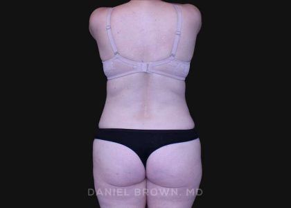 Tummy Tuck Before & After Patient #10916