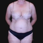 Tummy Tuck Before & After Patient #10916