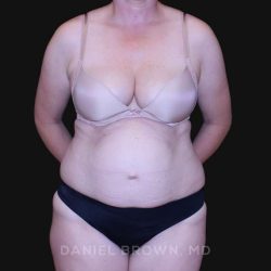 Tummy Tuck Before & After Patient #10916