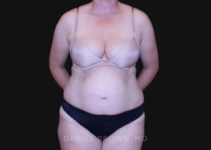 Tummy Tuck Before & After Patient #10916