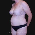 Tummy Tuck Before & After Patient #10916