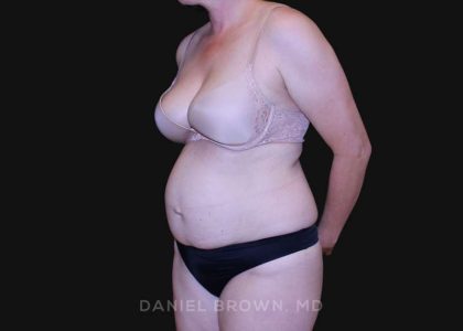 Tummy Tuck Before & After Patient #10916