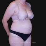 Tummy Tuck Before & After Patient #10916
