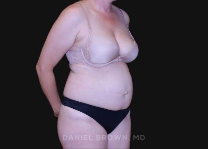 Tummy Tuck Before & After Patient #10916