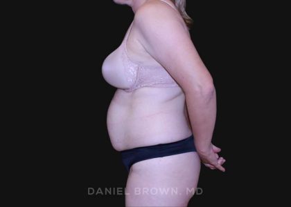 Tummy Tuck Before & After Patient #10916