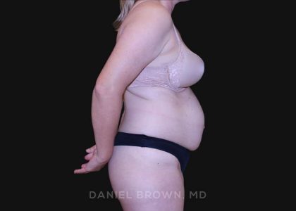 Tummy Tuck Before & After Patient #10916