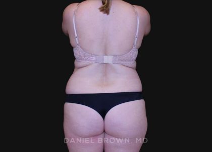 Tummy Tuck Before & After Patient #10916