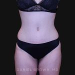 Tummy Tuck Before & After Patient #10929